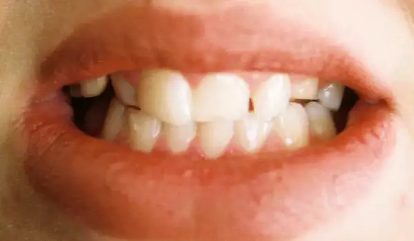 Ispadanje zuba